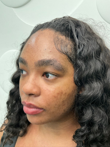 Laser Genesis treatment before and after photos